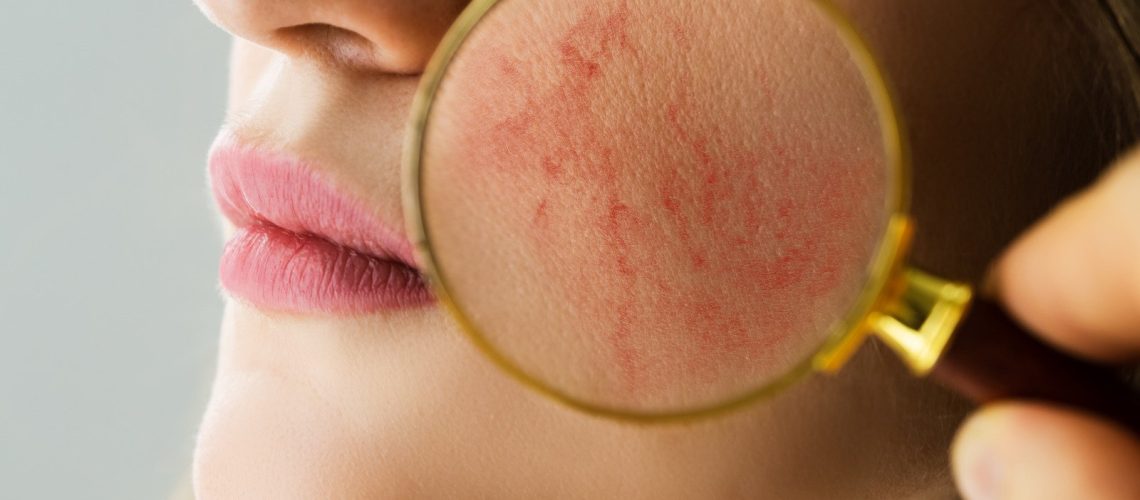 Rosacea Patients