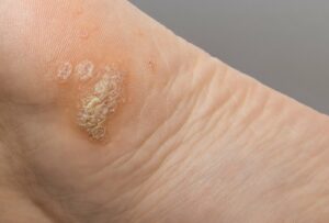 warts contagious, plantar wart