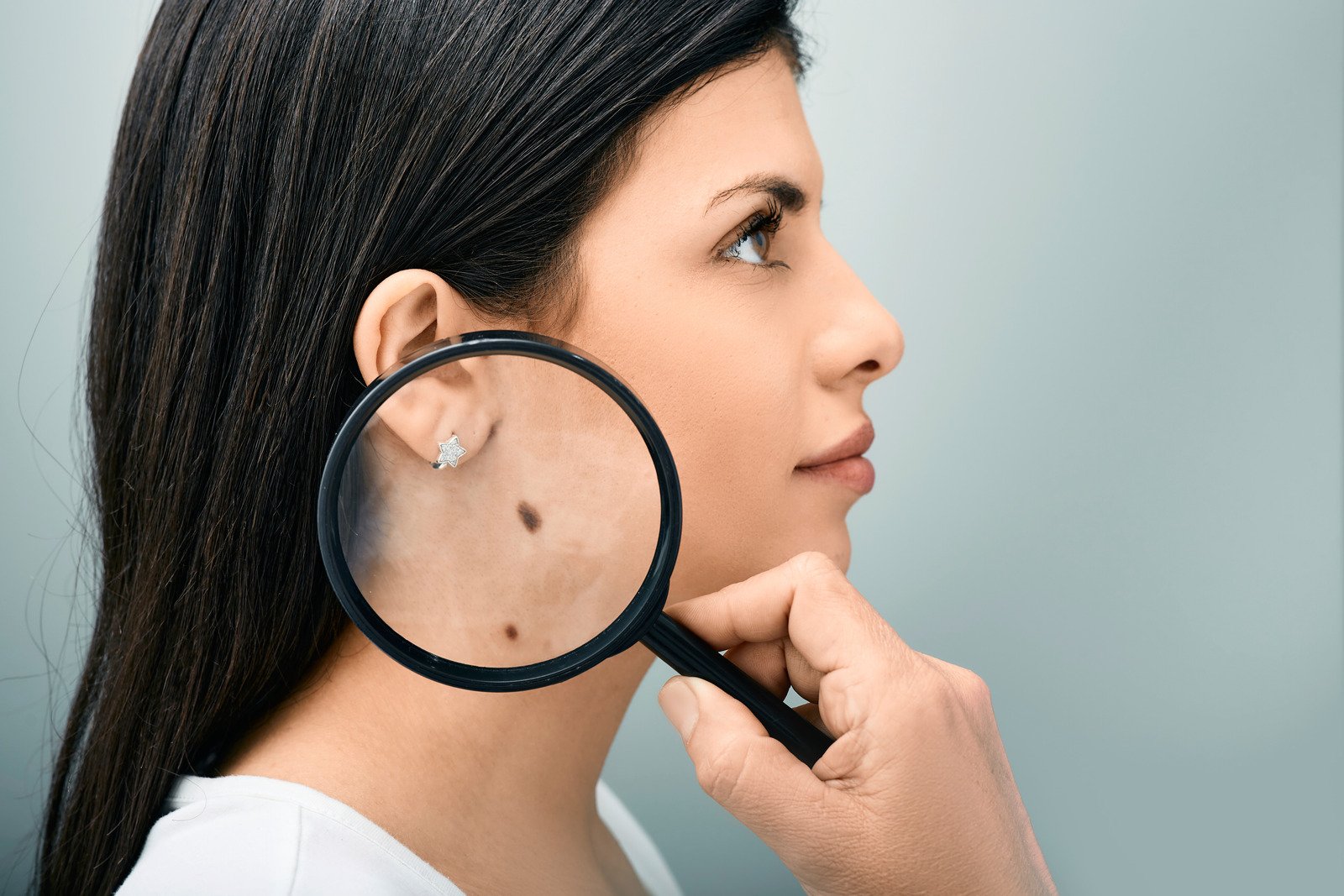 Skin Moles to Worry About - High Valley Dermatology