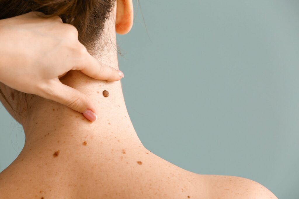 Skin Moles to Worry About - High Valley Dermatology