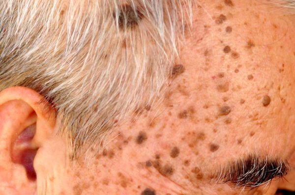 Seborrheic Keratosis